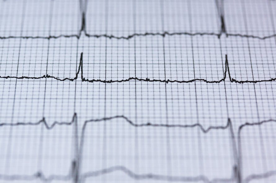 ECG Elettrocardiogramma